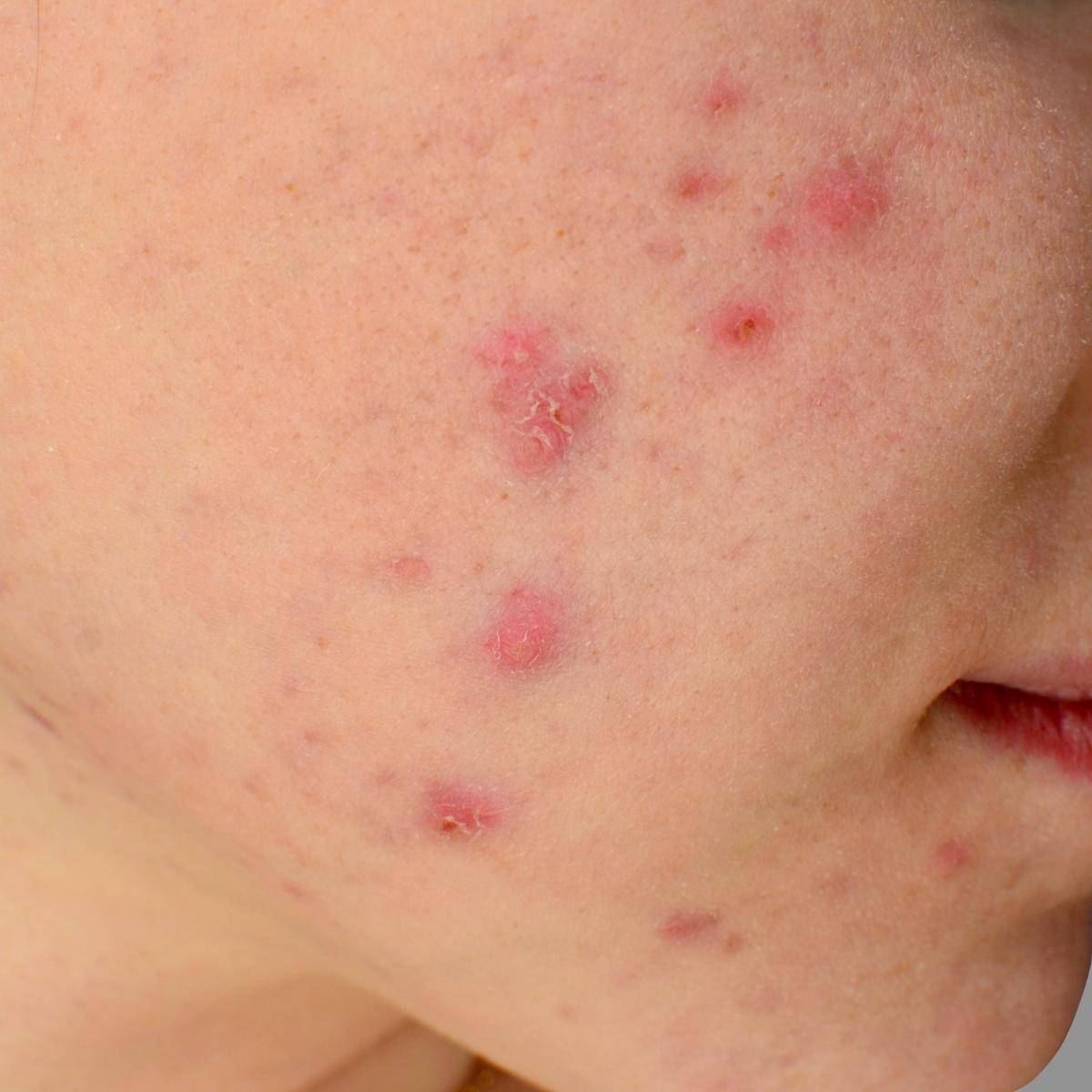 Know What Foods Cause Acne and Find the Right Solutions