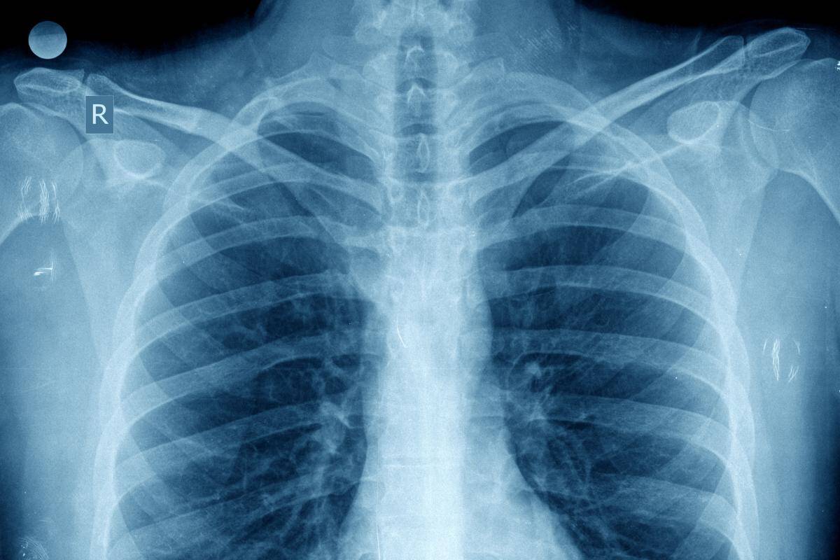 X-ray image of a human chest showing ribs, spine, shoulders, and lungs
